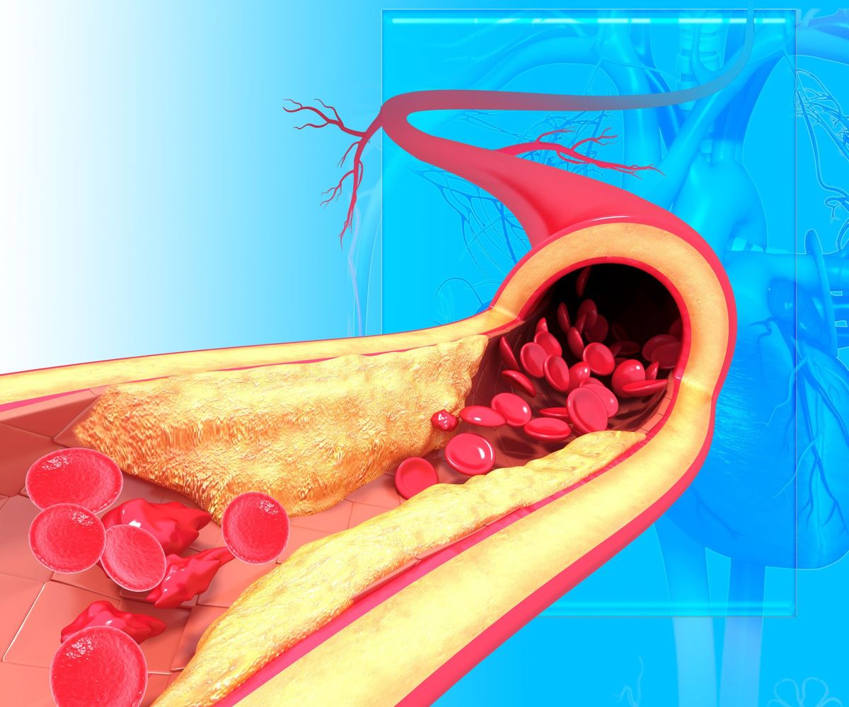 Guida di base alla comprensione dell'arteriosclerosi dell'aorta