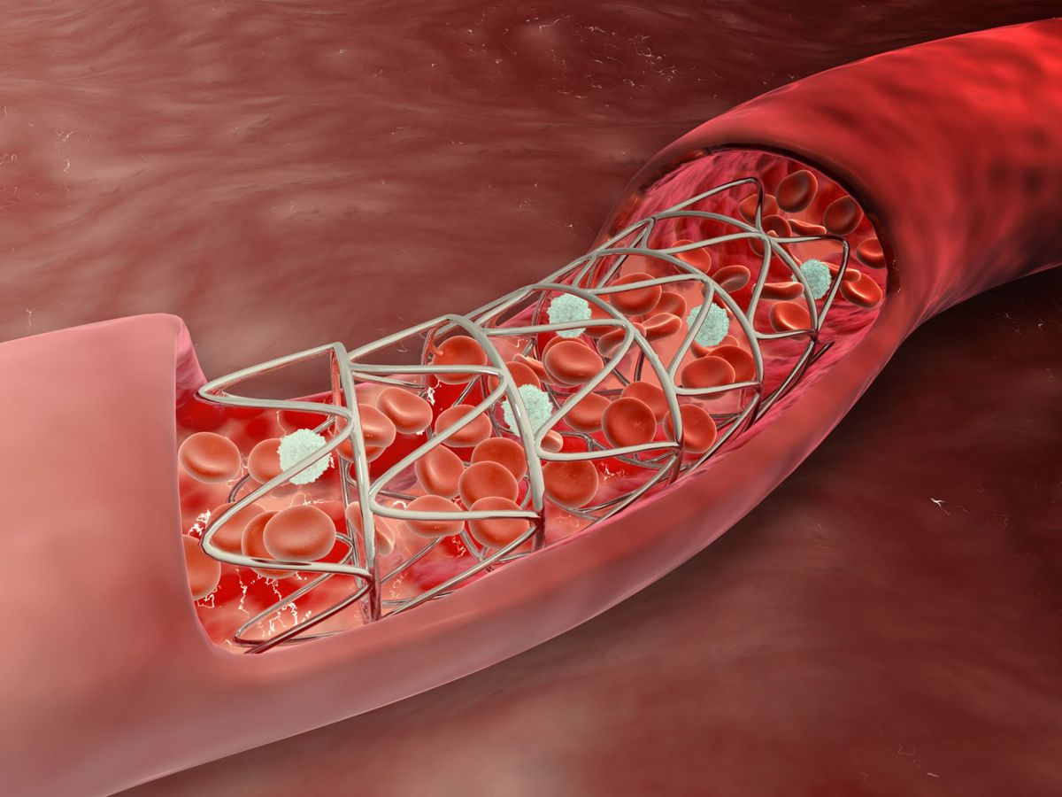 Quel est le stent coronaire?