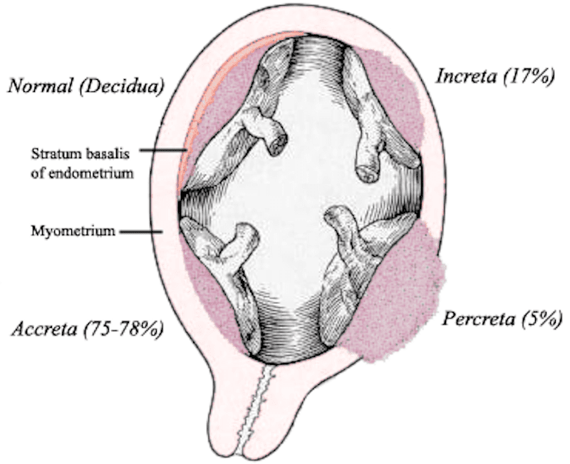 Rischi, cause e trattamento della placenta accreta, increta e percreta