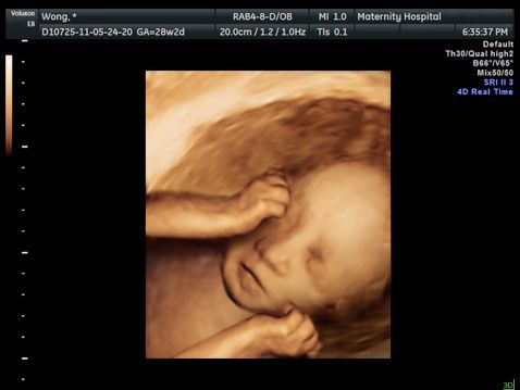 Ultrazvuk v těhotenství, co to je a proč to potřebujete